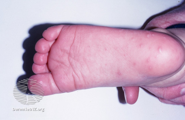A child's foot with small blisters