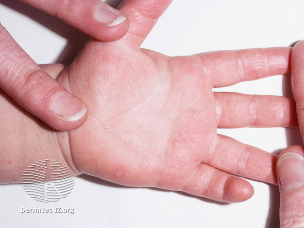 A child's hand showing small blisters on the palm