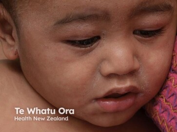 Measles rash on face (Credit: DermNet)