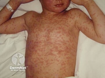 Measles rash on body (Credit: DermNet)