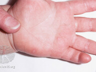 Hand, foot and mouth disease-icon