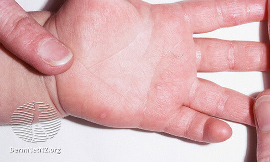 plunket hand foot mouth disease